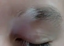 علت سفید شدن ابرو در جوانی چیست؟
