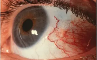 چگونه از خشکی چشم در هوای سرد زمستان پیشگیری کنیم؟
