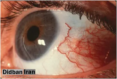 چگونه در هوای آلوده از چشم‌ها محافظت کنیم؟