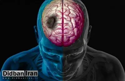 سکته مغزی ۱۴۰ هزار ایرانی در سال