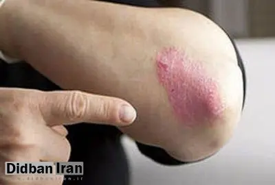 پسوریازیس بیماری که  بیش از ۱۰۰ میلیون نفر در جهان را درگیر خود کرده است