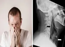 سوراخ شدن گلو بر اثر نگهداشتن عطسه/ عکس
