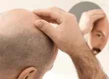 کدام کشورها بیشترین شمار مردان طاس را دارد؟