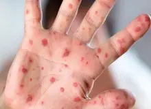 طغیان سرخک در مرزهای ایران 