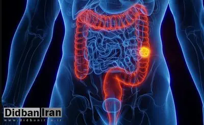 افزایش نگرانکنندهی سرطانهای گوارشی در جوانان