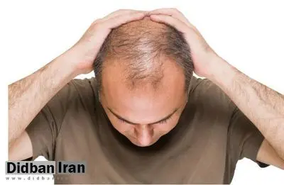 ۵ راه مبارزه با ریزش مو پس از بهبودی کرونا