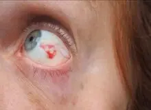 لکه‌ی خونی در چشم؛ دلایل شایع و راه‌های پیشگیری از تکرار آن