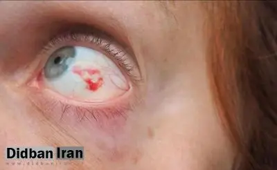 لکه‌ی خونی در چشم؛ دلایل شایع و راه‌های پیشگیری از تکرار آن