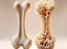 ۸۰ درصد مبتلایان پوکی استخوان از بیماری خود خبر ندارند