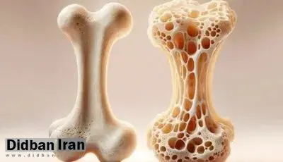 ۸۰ درصد مبتلایان پوکی استخوان از بیماری خود خبر ندارند