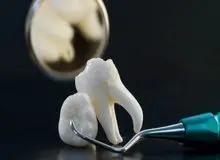 چند نکته درباره دندان عقل