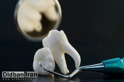 چند نکته درباره دندان عقل