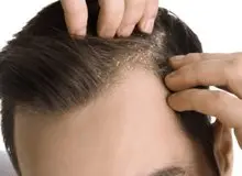 چرا سر شوره می‌زند؟
