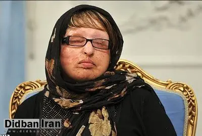 آمنه بهرامی، قربانی اسیدپاشی: پشیمانم که بخشیدم!/ دیه‌ام هنوز پرداخت نشده است
