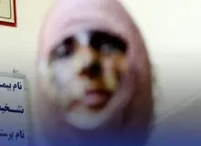 اسید پاشی برادر به صورت خواهرش / شاکی: برادرم بعد از حادثه، برایم پیامک فرستاد که اگر شکایت کنم، بلایی سرم می‌آورد که از زنده ماندن پشیمان شوم