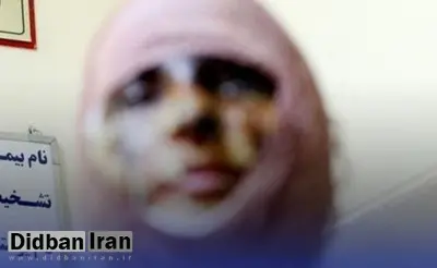 اسید پاشی برادر به صورت خواهرش / شاکی: برادرم بعد از حادثه، برایم پیامک فرستاد که اگر شکایت کنم، بلایی سرم می‌آورد که از زنده ماندن پشیمان شوم