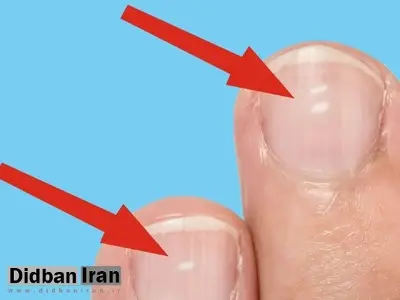 لکههای سفید روی ناخن نشانه چیست؟