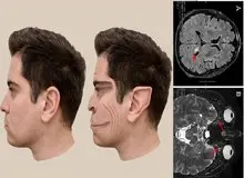 بیماری"لبخند شیطانی" چیست؟ + تصاویر