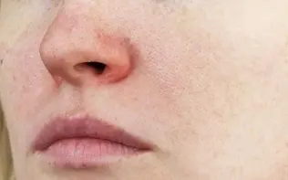 چگونه در چند روز خشکی و پوسته‌های اطراف بینی را برطرف کنیم؟