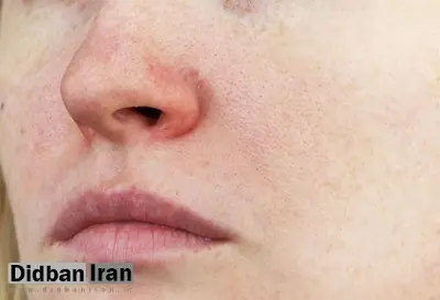 چگونه در چند روز خشکی و پوستههای اطراف بینی را برطرف کنیم؟