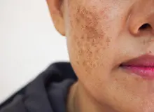 کمبود کدام ویتامین باعث لک صورت می‌شود؟