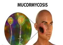 بیماری «قارچ سیاه» چگونه وارد بدن می‌شود؟+علائم بیماری قارچ سیاه