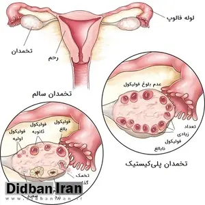 علائم کیست تخمدان چیست؟