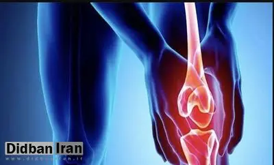 پرتودرمانی، درد شایع‌ترین نوع آرتروز را کاهش می‌دهد
