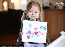 دختر شیشه ای که همه استخوان هایش شکسته است+عکس