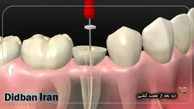 همه آنچه که باید درباره عصب کشی بدانید: از عوارض عصب کشی تا عصب کشی با لیزر و عصب کشی مجدد