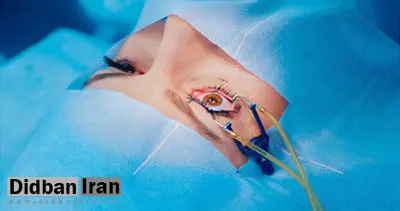 دبیر علمی کنگره چشم‌پزشکی ایران: ازدواج فامیلی سبب افزایش بیماری‌های ارثی شده