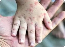 وضعیت بروز آبله‌مرغان در ایران