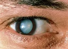 دیابت، از عوامل بروز بیماری های شبکیه چشم است