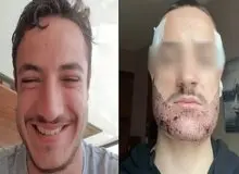 خودکشی بخاطر بد شدن کاشت ریش/ این پسر فرانسوی تا استانبول برای کاشت ریش رفته بود