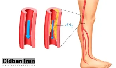 تغییراتی برای بهبود گردش خون در پاها