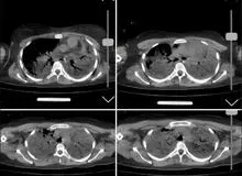 ارگان رسانه ای نزدیک به سپاه: تصاویر سی تی اسکن منتشر شده از «مهسا امینی» توسط ایران اینترنشنال، مربوط به اوست