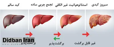 علائم و نشانههای ظاهری و بالینی بیماری کبد چرب را بشناسید