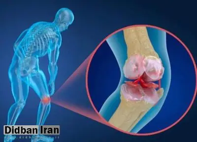 ابتلای ۳۷ درصد زنان بالای ۵۰ سال ایرانی به پوکی استخوان/ یک چهارم مردان بالای ۵۰ سال پوکی استخوان دارند