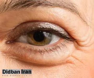 چرا صبح بعد بیدار شدن از خواب چشم هایم پف دارد؟