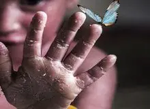 توییت معنادار سخنگوی اسبق وزارت بهداشت درباره کودکان پروانه‌ای