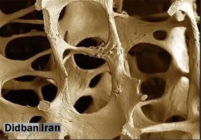 «پوکی استخوان» در مردها مرگبارتر از زنان است