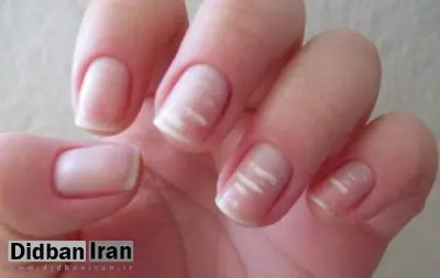 چرا روی ناخن لکه‌های سفید ایجاد می‌شود و راه درمان آن چیست؟