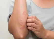  قرمزی پوست از علائم کروناست+جزییات 