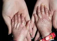 وزارت بهداشت: مفقودی پانسمان بیماران پروانه‌ای کذب است