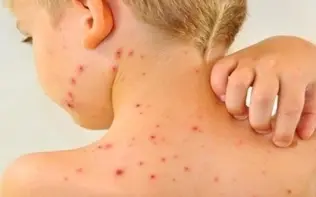 افزایش موارد ابتلا به سرخک در جهان با کاهش میزان واکسیناسیون
