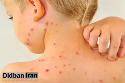 افزایش موارد ابتلا به سرخک در جهان با کاهش میزان واکسیناسیون
