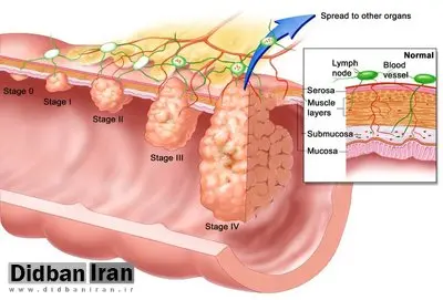استفاده از چای داغ، آمار مبتلایان به سرطان مری را افزایش میدهد