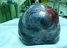 توده عجیب ۶ کیلویی از شکم خانم اردبیلی خارج شد+ عکس