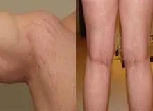 چگونه ترک‌های پوستی را از بین ببریم؟