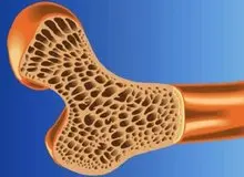 نیمی از جمعیت ایران پوکی استخوان دارند